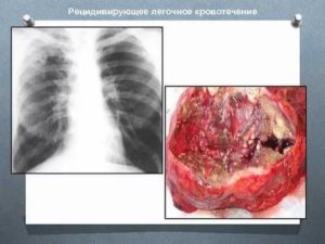 Кровотечение при туберкулезе легких
