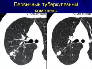 Томография легких при туберкулезе
