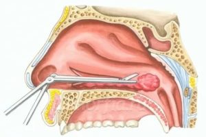 Резекция носовых раковин это