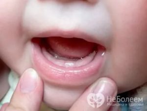 Как отличить прорезывание зубов от болезни