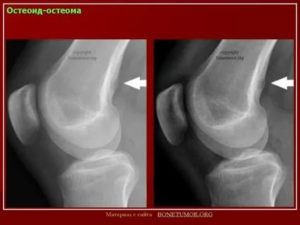 Остеома ребра причины