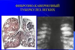 Фиброзно кавернозный туберкулез легких заразен или нет