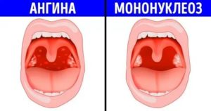 Как отличить мононуклеоз от ангины