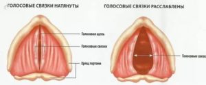 Перенапряжение голосовых связок лечение