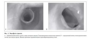 Стеноз трахеи у взрослых лечение