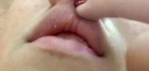 Нарыв на внутренней стороне губы