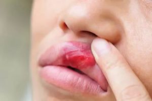 Болит губа с внутренней стороны