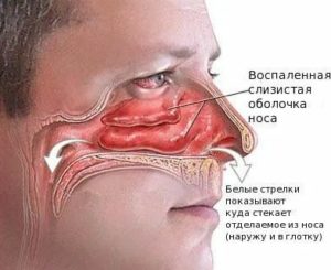 Почему закладывает нос после алкоголя