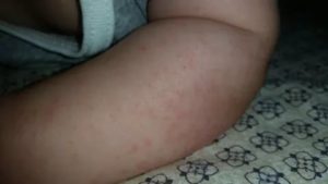 Аллергия на амоксициллин у ребенка