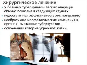 Операция на легкие при туберкулезе последствия