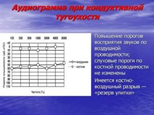 Расшифровка аудиограммы слуха