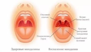 Красные миндалины у ребенка чем лечить