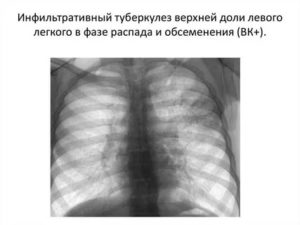 Инфильтративный туберкулёз в фазе распада