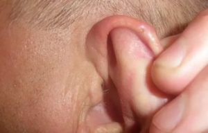 На ушной раковине болезненное уплотнение
