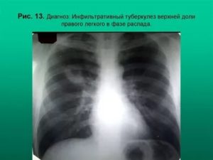 Инфильтративный туберкулёз в фазе распада