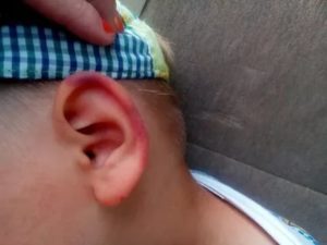Травма уха от удара