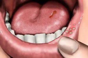 Как лечить воспаление слизистой полости рта