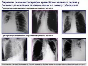Операция на легкие при туберкулезе последствия