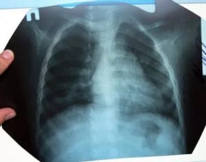 Повторный рентген при пневмонии