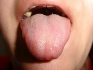 Болит язык сбоку слева