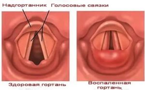 Перенапряжение голосовых связок лечение