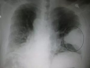 Рентген лёгких при пневмонии