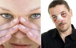 Что делать при ушибе носа