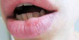 Воспаление на внутренней стороне губы