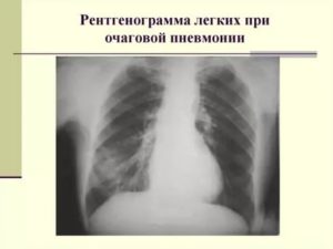 Очаговая пневмония рентген