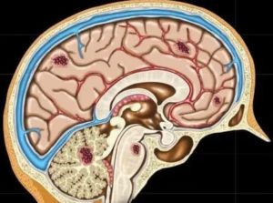 Синусопатия головного мозга что это такое