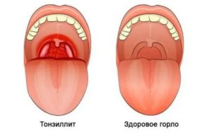 Белые прожилки на миндалинах у ребенка