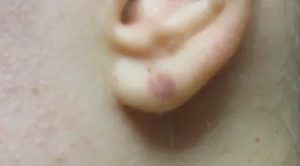 Мочка уха опухла и покраснела