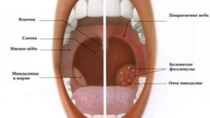 Как отличить тонзиллит от ангины