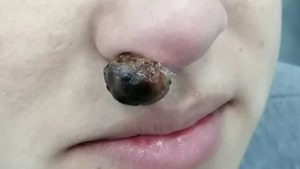 Опухоль в носу фото