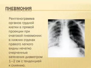 Описание пневмонии на рентгене