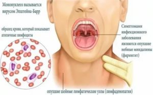 Как отличить мононуклеоз от ангины