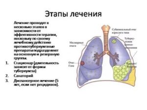 Можно ли вылечить туберкулез легких
