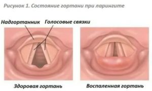 Болезни голосовых связок симптомы лечение