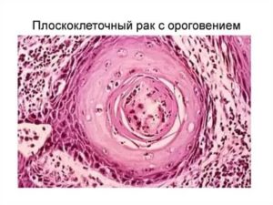 Плоскоклеточный рак с ороговением гортани