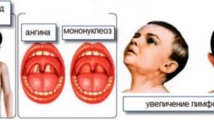 Как отличить мононуклеоз от ангины