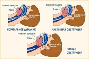 Задержка дыхания во сне у взрослых причины