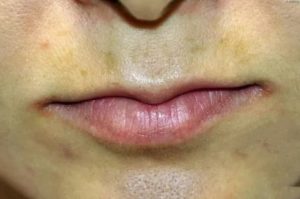 Болячка возле губы
