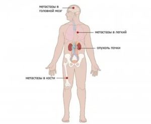 Если метастазы пошли в кости сколько живут