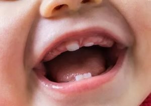 Как отличить прорезывание зубов от болезни