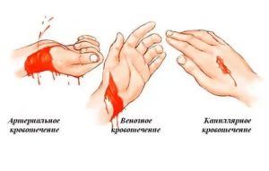 Как остановить кровь из вены на запястье