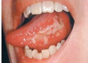 Химический ожог слизистой рта лечение