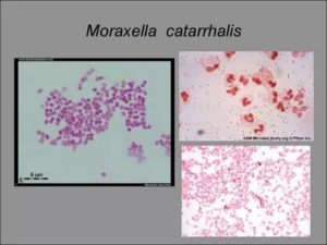 Моракселла катаралис лечение