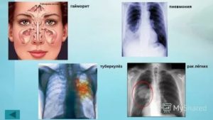 Пневмония и рак легких как отличить
