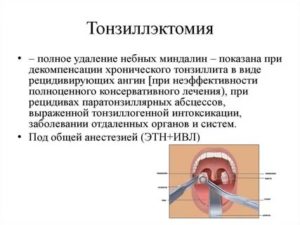 Частичное удаление миндалин лазером