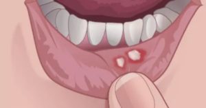 Воспаление на внутренней стороне губы